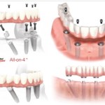 All on Four Dental Implants Image
