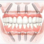 All on Four Dental Implants Picture