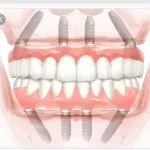All on Four Dental Implants Picture