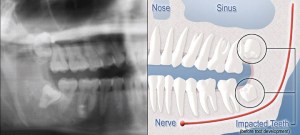 Diagram of impacted tooth